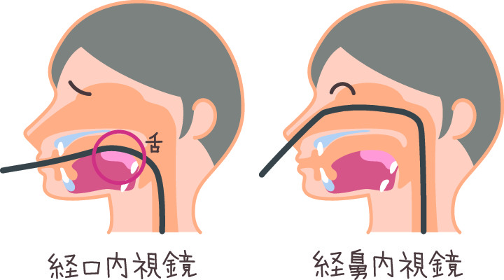 鼻経内視鏡 つらい